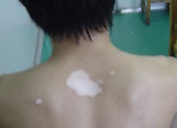 郑州市哪家医院专门治疗白癜风