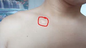 郑州哪家白癜风治疗医院比较好